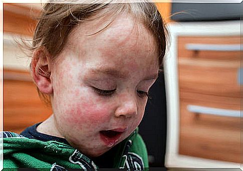 Child with rash on his face due to an allergy to cow's milk proteins
