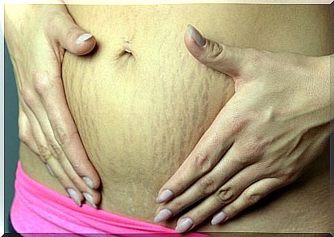 How to get rid of stretch marks during pregnancy?