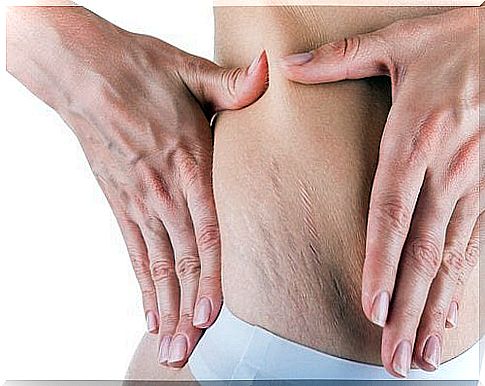 Stretch marks resemble scars - it is impossible to make them disappear completely