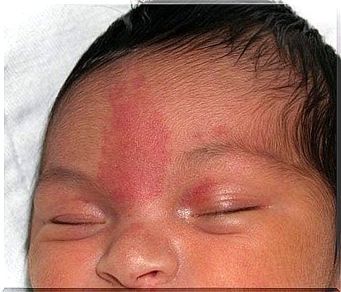 Infant spots are very common and usually harmless